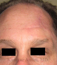 Forehead-large-3-B