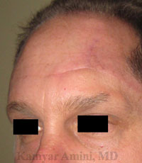 Forehead-large-4-B