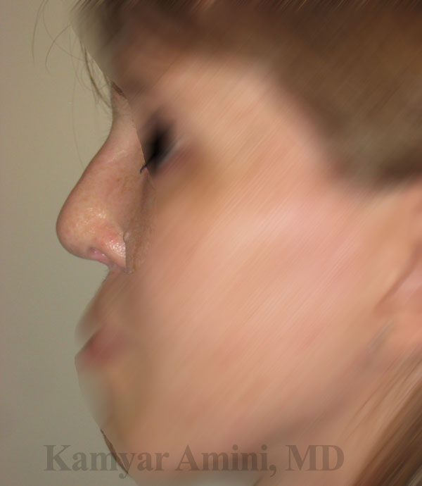Augmentation-Rhinoplasty-6A.jpg