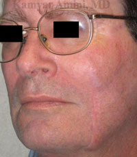 Cheek-large-B.jpg