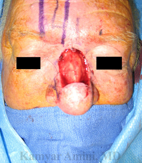 Full-nasal-dorsum-A.jpg
