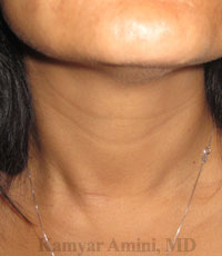 Parathyroid-30sB