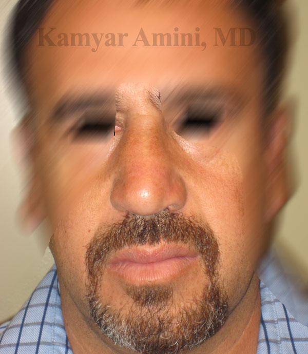 Reallignment-RhinoplastyA.jpg