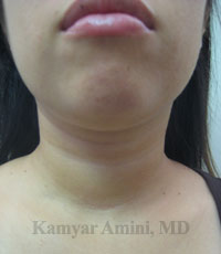 Thyroid-20s-3B