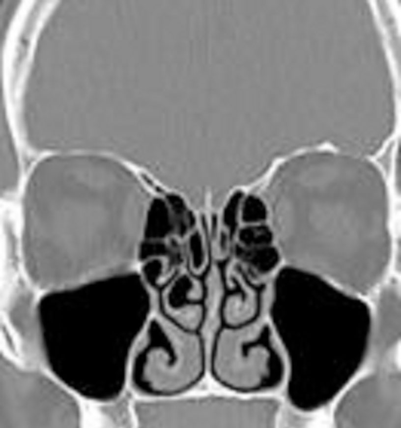 Turbinoplasty_ent_doctor_LA_1