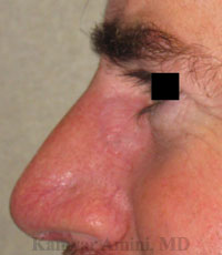 Upper-Nasal-Sidewall-3-B.jpg