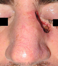 Upper-Nasal-Sidewall-5-B.jpg