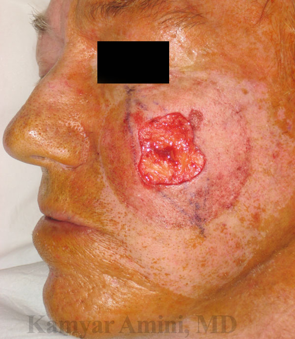 cheek1-A.jpg
