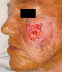 cheek1-B