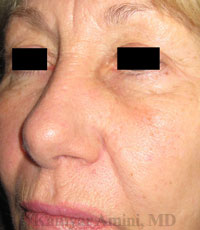 nostril1-B