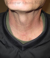 thyroid1-B.jpg