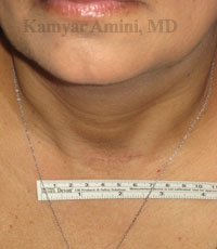 thyroid4-B.jpg